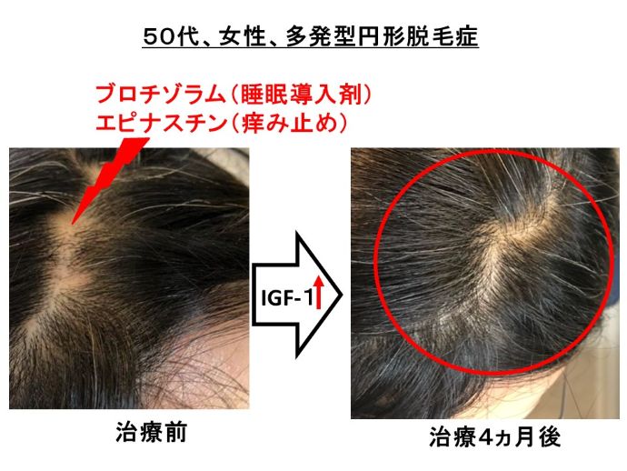 円形脱毛症　病院